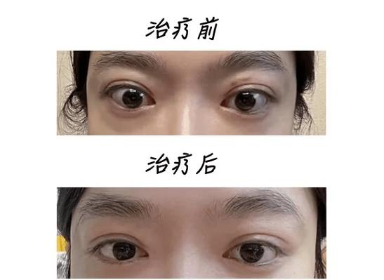甲亢眼突一般几年恢复
