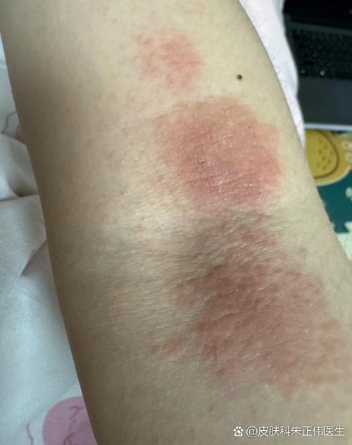 胳膊突然起了一片疙瘩很痒