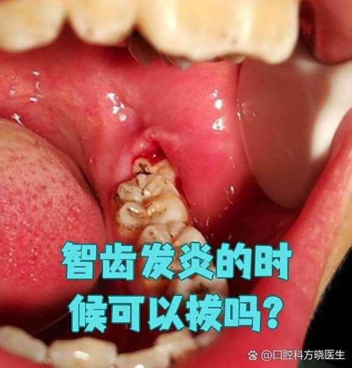 智齿发炎了能拔牙吗