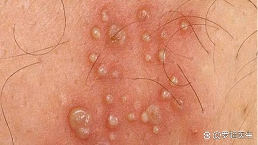 人乳头瘤病毒hpv是什么意思