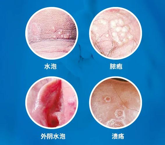 男性生殖部位有水泡用什么药