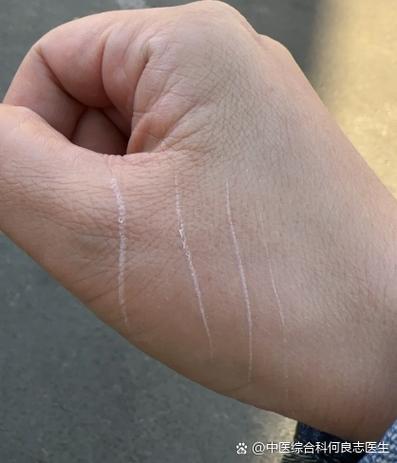 被猫咪抓破了很浅的一层皮有事吗