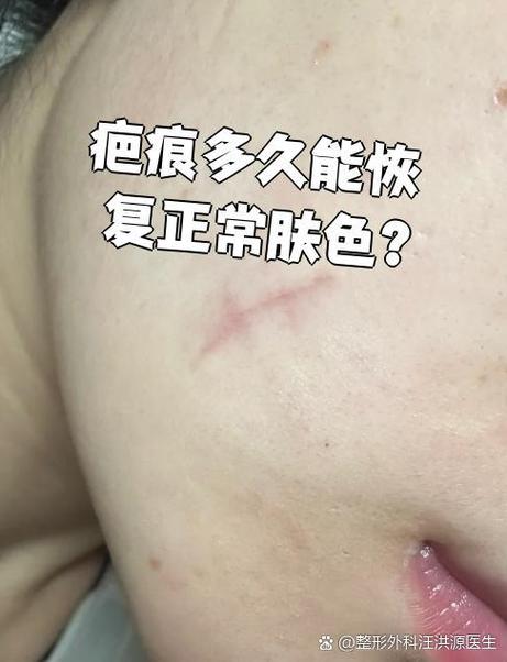 疤痕多长时间恢复正常皮肤颜色