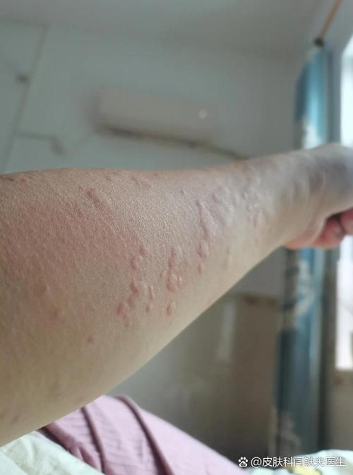 胳膊弯痒一挠就起疙瘩