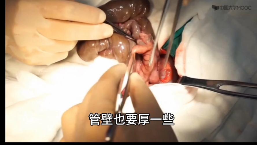 阑尾炎手术模拟视频