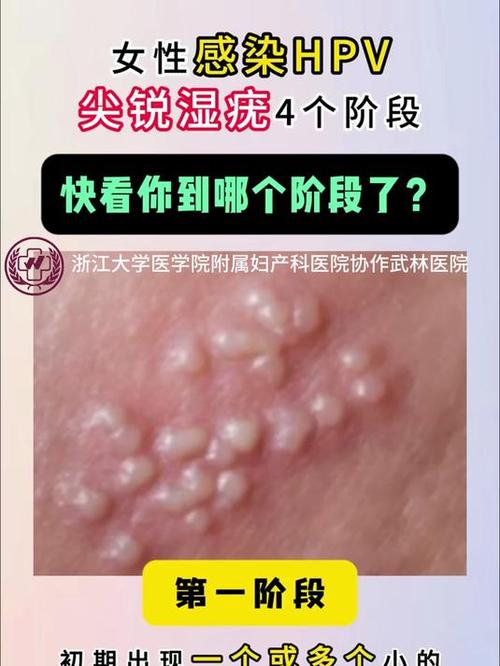 hpv是怎么得来的女性