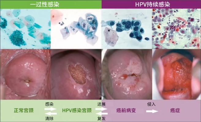 hpv是怎么得来的女性截图2