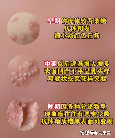 hpv是怎么得来的女性截图3