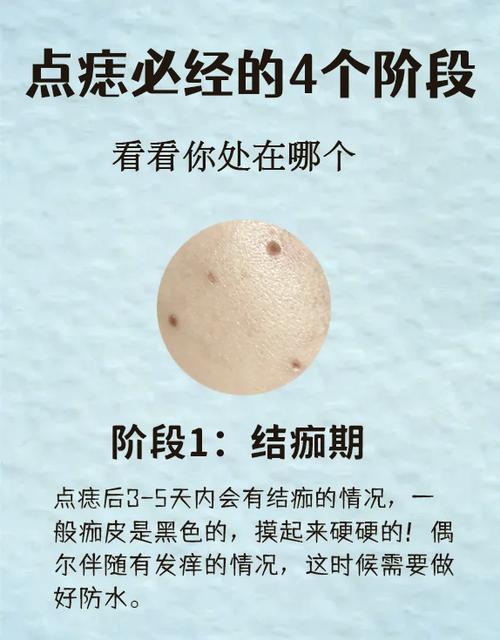 点痣落坑怎么恢复快