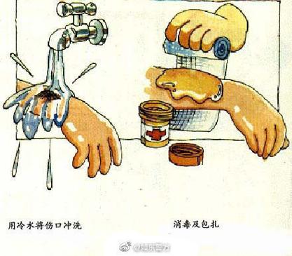 火焰烧伤怎么处理