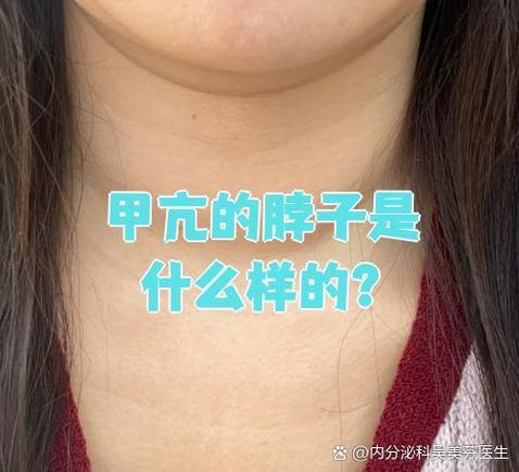 甲亢一定会脖子大吗