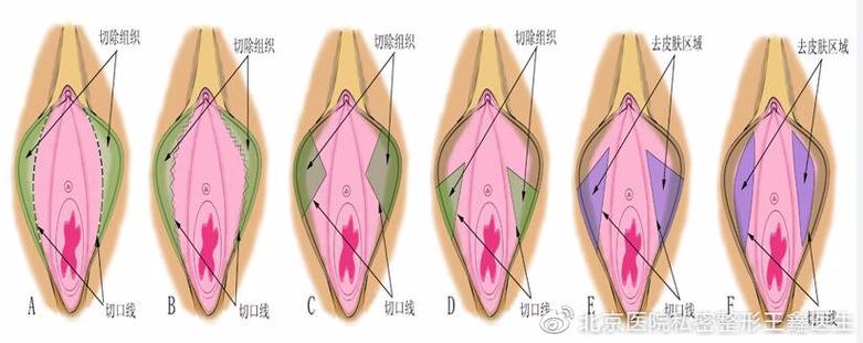 女性私密手术包括什么项目