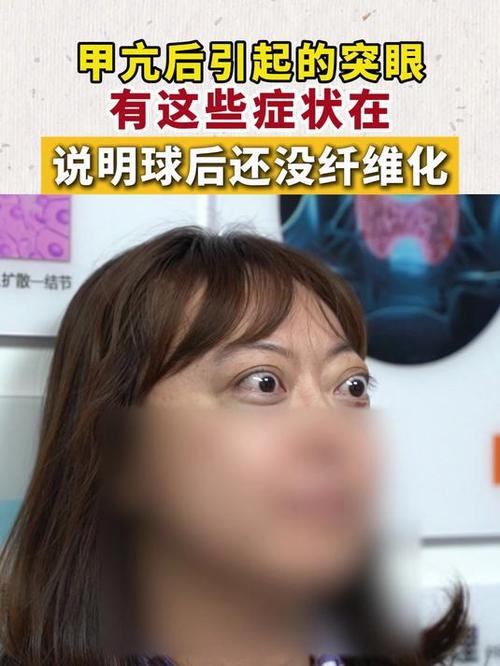 甲亢什么程度才会突眼