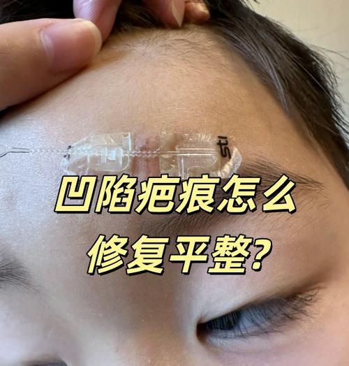 十几年的凹陷疤痕可以修复吗