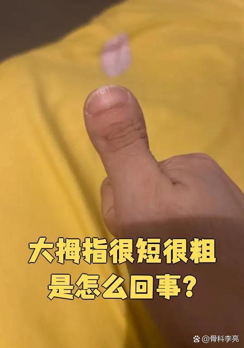 大拇指短