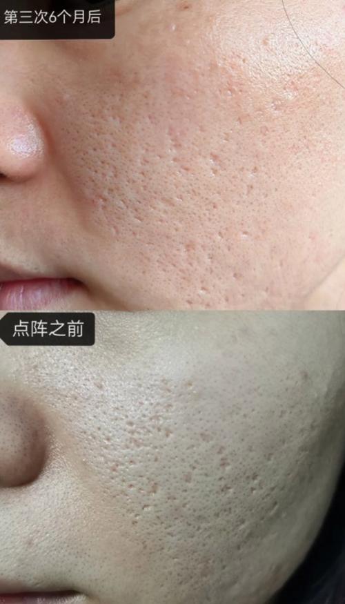 痘坑怎么才能恢复