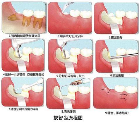 下智齿拔了有个洞怎么办