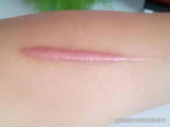 做激光留下的疤痕还能修复吗?