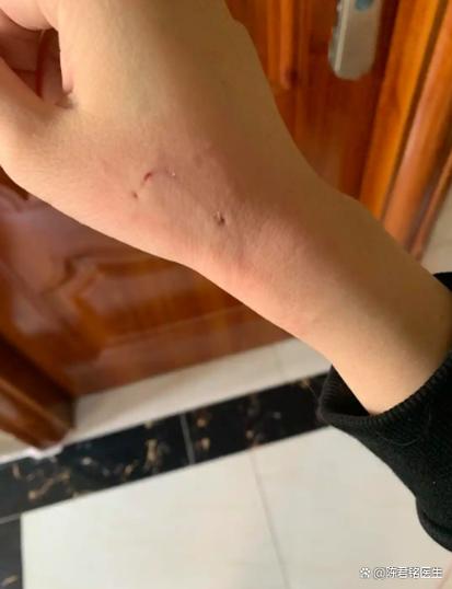 被猫咪轻轻咬了一下