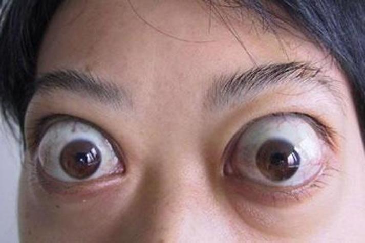 甲亢一定会眼睛突出吗