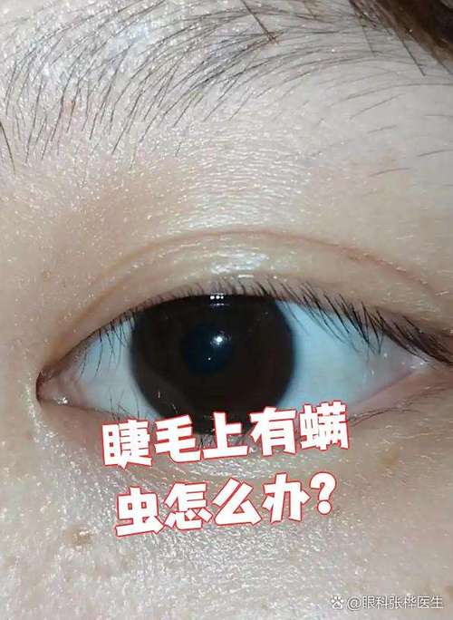睫毛螨虫什么原因引起的