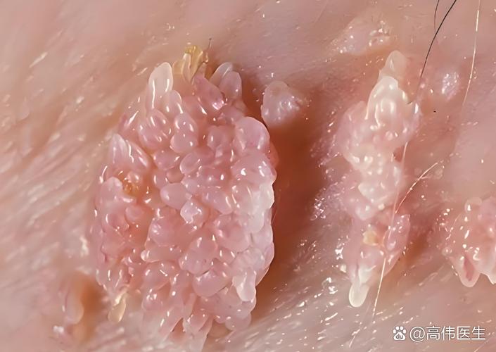 女性怎么会得hpv病毒