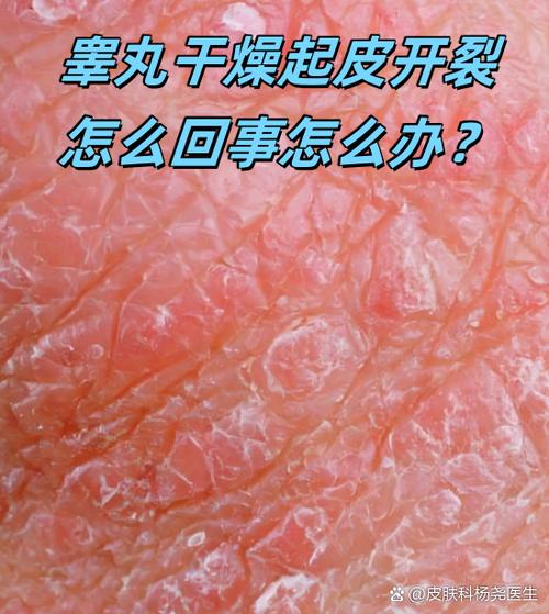 睾丸脱皮痒干燥起鳞片是什么原因