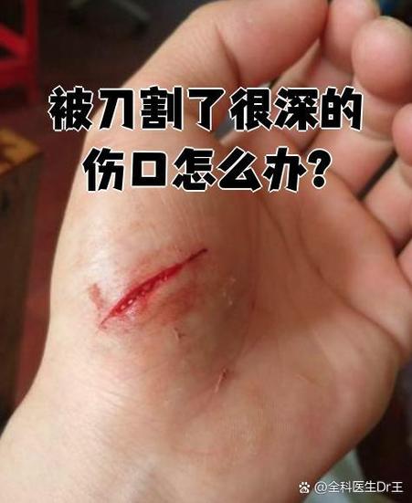被水果刀划伤怎么止血