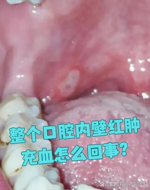 引起口腔溃疡的原因
