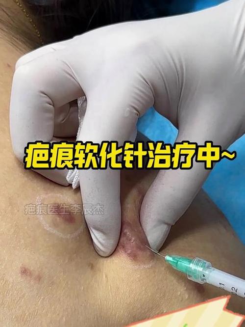 疤痕硬怎么才能软化快