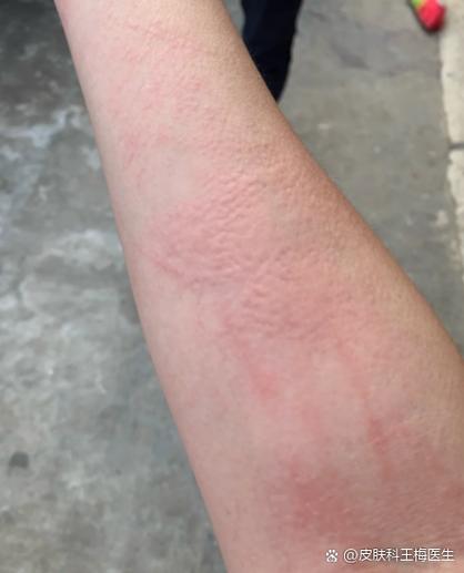 胳膊刺挠一挠就起疙瘩