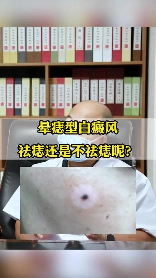 晕痣把痣点了白斑会慢慢恢复吗